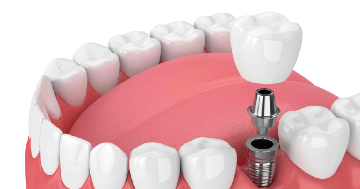 De ce Procedura de Sinus Lift Poate Fi cea Mai Bună Alegere Înainte de Implanturile Dentare